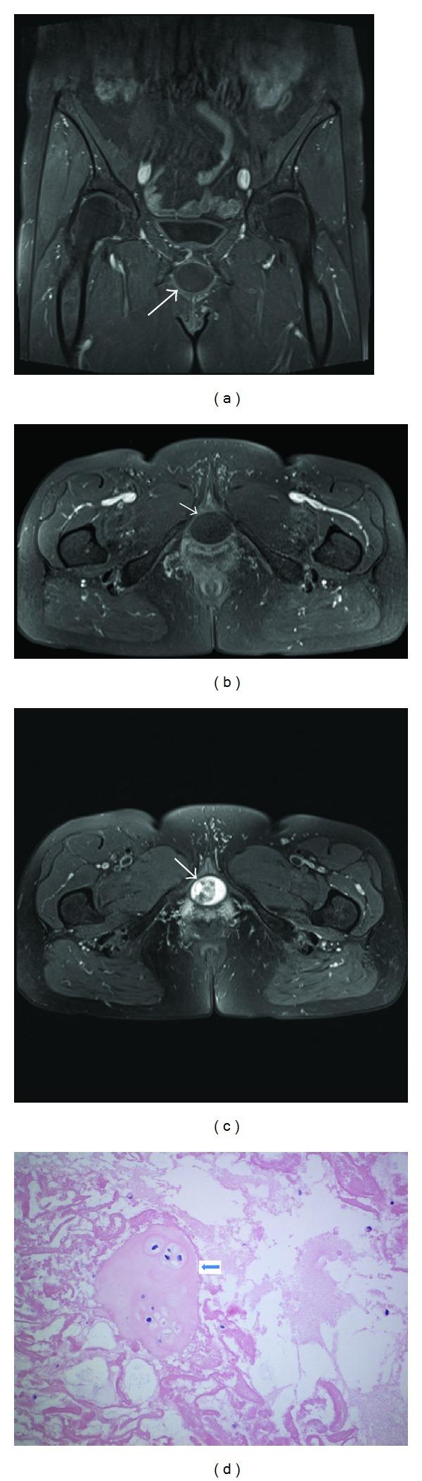 https://cdn.ncbi.nlm.nih.gov/pmc/blobs/a5ac/3914336/606c3e445565/CRIM.UROLOGY2014-176089.001.jpg