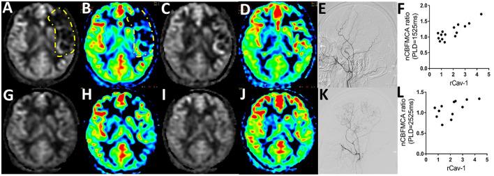 https://cdn.ncbi.nlm.nih.gov/pmc/blobs/a5d2/9086974/61b932bd4410/fneur-13-796339-g0003.jpg
