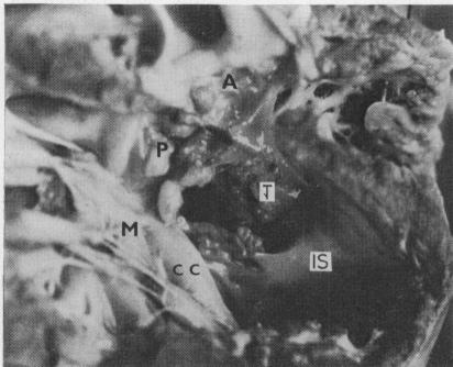 https://cdn.ncbi.nlm.nih.gov/pmc/blobs/a5e9/482106/a2eb479507d6/brheartj00209-0025-b.jpg