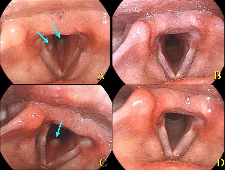 https://cdn.ncbi.nlm.nih.gov/pmc/blobs/a5f6/12335347/61fc8157913e/cureus-0017-00000087684-i02.jpg