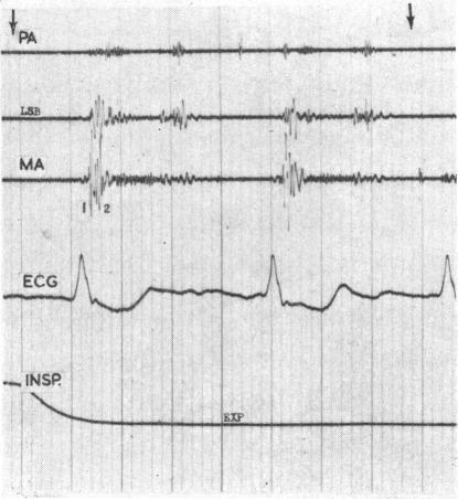 https://cdn.ncbi.nlm.nih.gov/pmc/blobs/a627/490138/619cc354a593/brheartj00336-0098-b.jpg