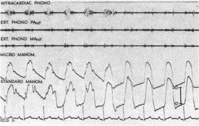 https://cdn.ncbi.nlm.nih.gov/pmc/blobs/a627/490138/c4c6280c7811/brheartj00336-0100-b.jpg