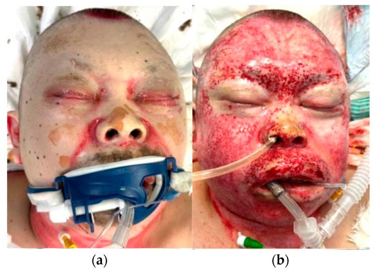 https://cdn.ncbi.nlm.nih.gov/pmc/blobs/a6cb/12347264/52d869c0a7c8/jcm-14-05233-g003.jpg