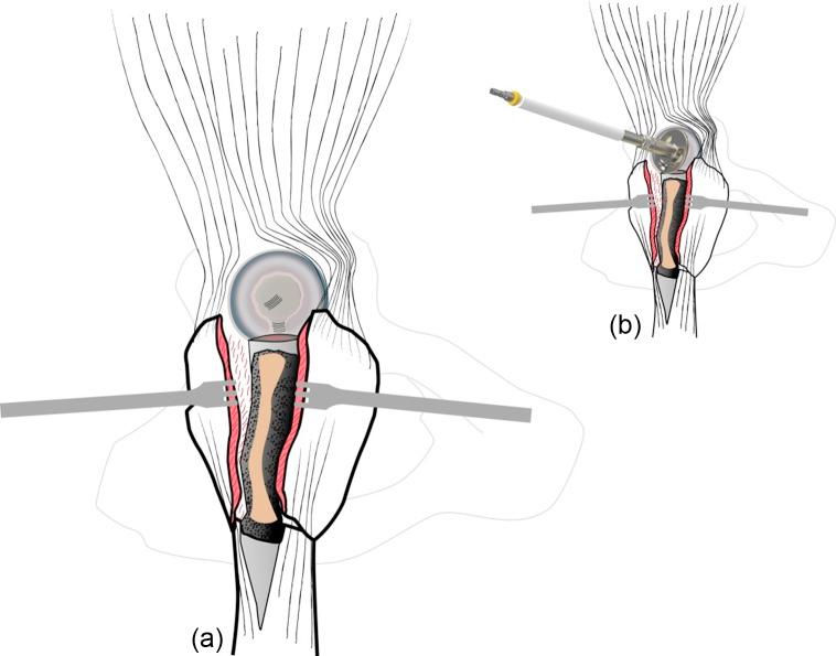 https://cdn.ncbi.nlm.nih.gov/pmc/blobs/a6db/4849249/83bb0c286541/sicotj-1-7-fig6.jpg