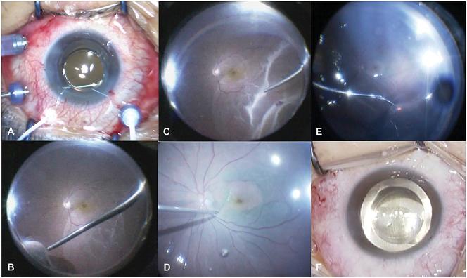 https://cdn.ncbi.nlm.nih.gov/pmc/blobs/a6ed/5690303/1569d84a5bcd/retina-37-2130-g001.jpg