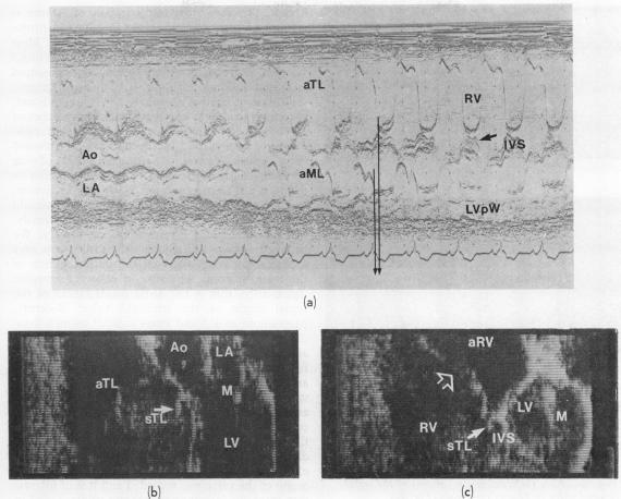https://cdn.ncbi.nlm.nih.gov/pmc/blobs/a6f0/482238/87854e03917b/brheartj00191-0043-a.jpg