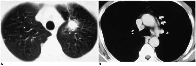https://cdn.ncbi.nlm.nih.gov/pmc/blobs/a6fe/2686426/a357cbd4b897/kjr-6-94-g002.jpg