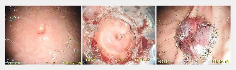 https://cdn.ncbi.nlm.nih.gov/pmc/blobs/a718/5396862/d2f6dcde0a5c/10-1055-s-0043-101692-i679ei2.jpg