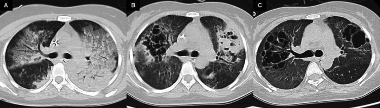https://cdn.ncbi.nlm.nih.gov/pmc/blobs/a75c/11521961/6e3cf91567b6/cureus-0016-00000070463-i05.jpg