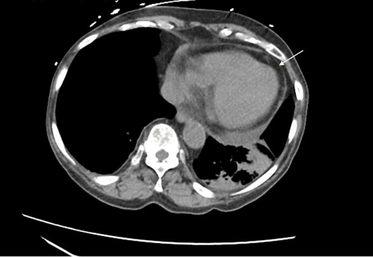https://cdn.ncbi.nlm.nih.gov/pmc/blobs/a782/11849800/6233c29c8bd9/cureus-0017-00000077976-i02.jpg