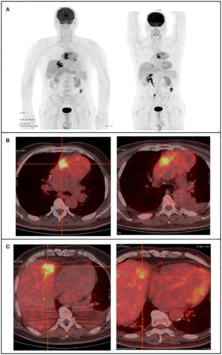 https://cdn.ncbi.nlm.nih.gov/pmc/blobs/a7a3/7438761/085d11fa2e65/fonc-10-01215-g0001.jpg
