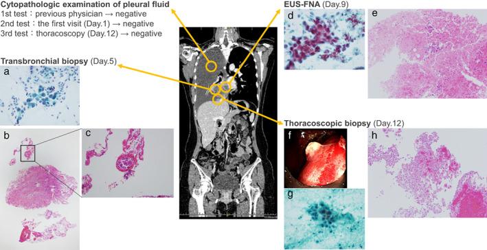 https://cdn.ncbi.nlm.nih.gov/pmc/blobs/a7d5/9807439/d499d8f0fba4/TCA-14-85-g002.jpg