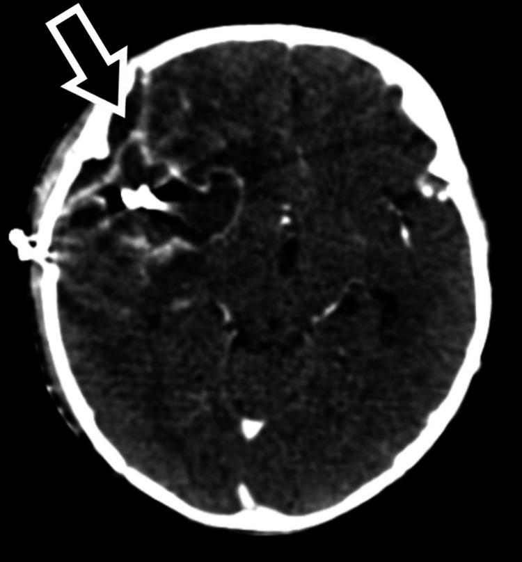 https://cdn.ncbi.nlm.nih.gov/pmc/blobs/a82e/11293608/655a302cb9c2/cureus-0016-00000063684-i05.jpg