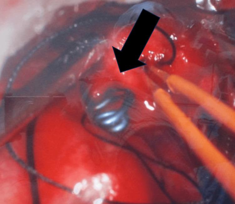 https://cdn.ncbi.nlm.nih.gov/pmc/blobs/a82e/11293608/6d8be202bf87/cureus-0016-00000063684-i04.jpg