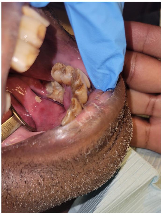 https://cdn.ncbi.nlm.nih.gov/pmc/blobs/a868/10217705/e4094d8f800b/dentistry-11-00136-g007.jpg