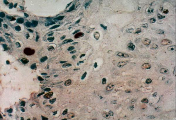 https://cdn.ncbi.nlm.nih.gov/pmc/blobs/a876/2611966/07dc7d65ff3e/1746-1596-3-45-5.jpg