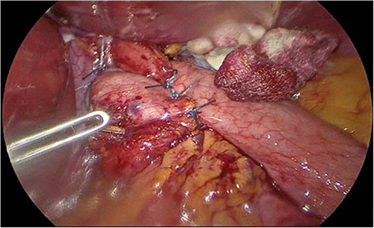 https://cdn.ncbi.nlm.nih.gov/pmc/blobs/a89d/12003324/1c994e157c68/fsurg-12-1513695-g003.jpg