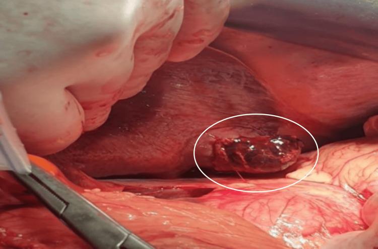https://cdn.ncbi.nlm.nih.gov/pmc/blobs/a8bc/12130909/3984d1f30409/cureus-0017-00000083441-i02.jpg