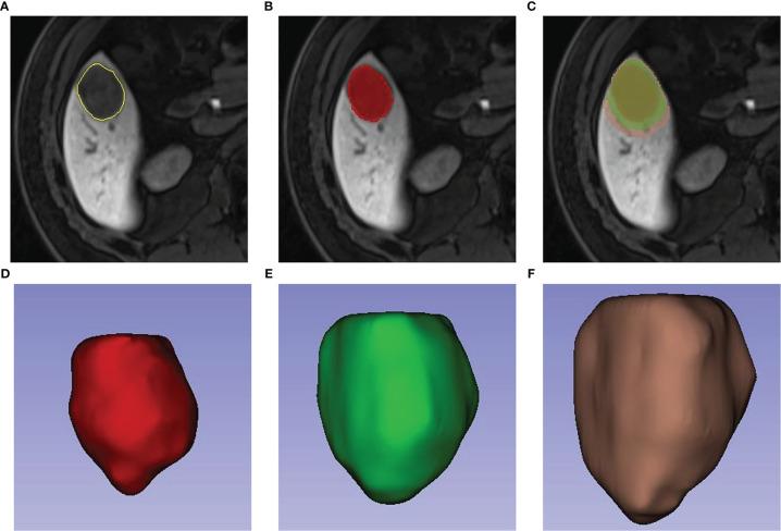 https://cdn.ncbi.nlm.nih.gov/pmc/blobs/a966/8981726/f98a1b77c316/fonc-12-853336-g002.jpg