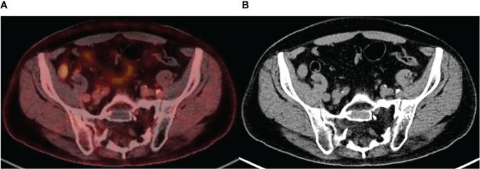 https://cdn.ncbi.nlm.nih.gov/pmc/blobs/a990/9294166/bbb3d25ae39a/fonc-12-936993-g003.jpg
