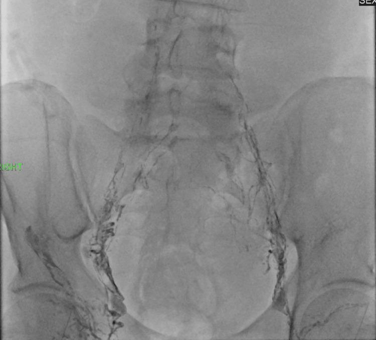 https://cdn.ncbi.nlm.nih.gov/pmc/blobs/a9ab/12185150/a962c5af814a/cureus-0017-00000084754-i01.jpg