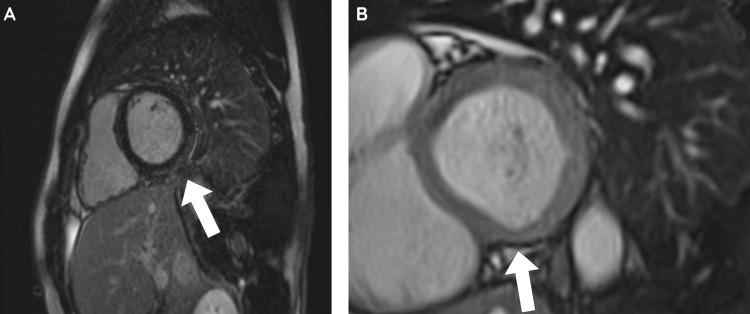 https://cdn.ncbi.nlm.nih.gov/pmc/blobs/aa70/12123056/3a6c16f6ad77/cureus-0017-00000083224-i02.jpg
