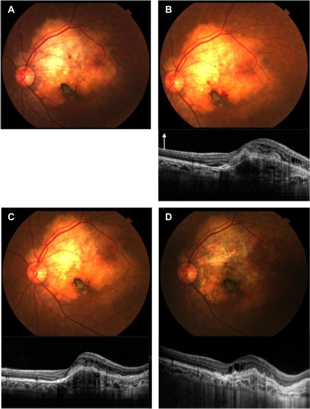 https://cdn.ncbi.nlm.nih.gov/pmc/blobs/aa7d/4356687/00f443fa8478/opth-9-429Fig4.jpg