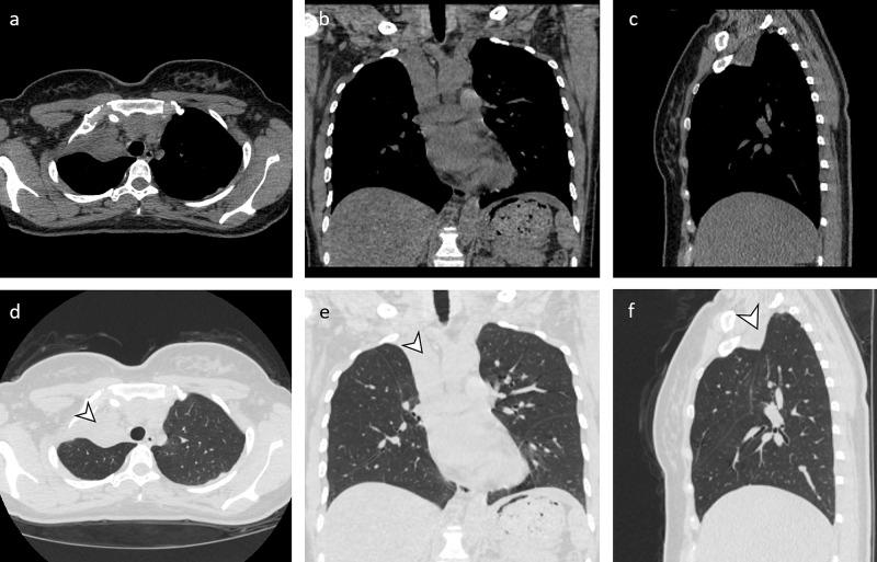 https://cdn.ncbi.nlm.nih.gov/pmc/blobs/aa96/7883571/eb1845be81da/cureus-0013-00000012717-i02.jpg