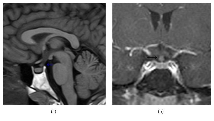https://cdn.ncbi.nlm.nih.gov/pmc/blobs/aa9d/4904552/6a863c8d5e8c/CRJ2016-3740902.003.jpg