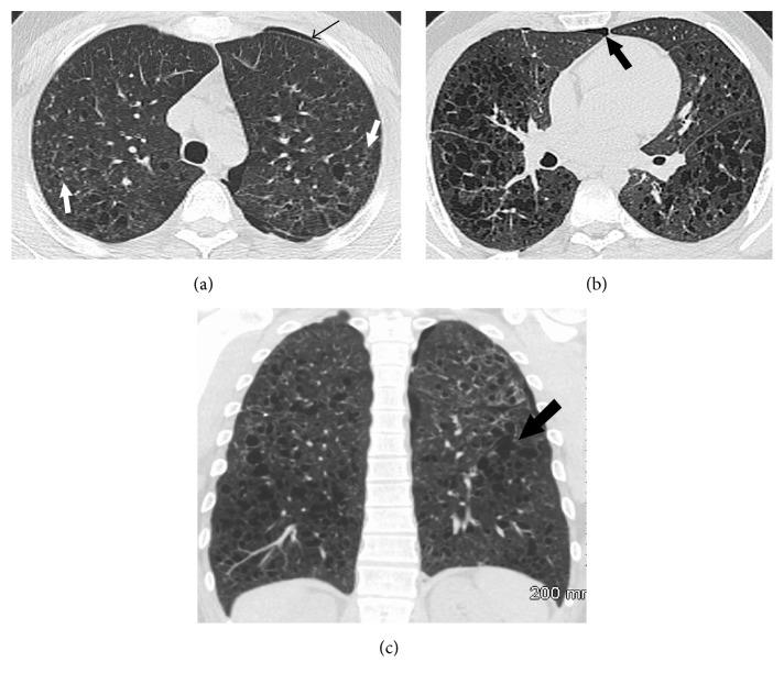 https://cdn.ncbi.nlm.nih.gov/pmc/blobs/aa9d/4904552/70d1acdab26e/CRJ2016-3740902.001.jpg