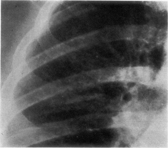 https://cdn.ncbi.nlm.nih.gov/pmc/blobs/ab00/470850/71c73ab72581/thorax00157-0084-a.jpg