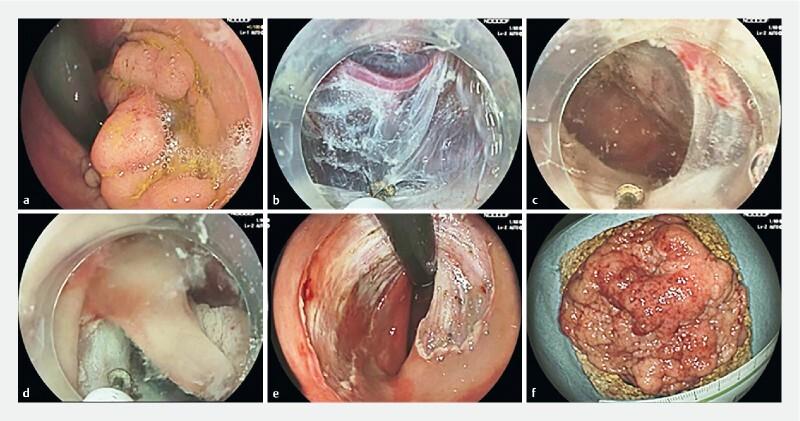 https://cdn.ncbi.nlm.nih.gov/pmc/blobs/ab43/9473857/311286801cc6/10-1055-a-1882-4306-i2597ei2.jpg