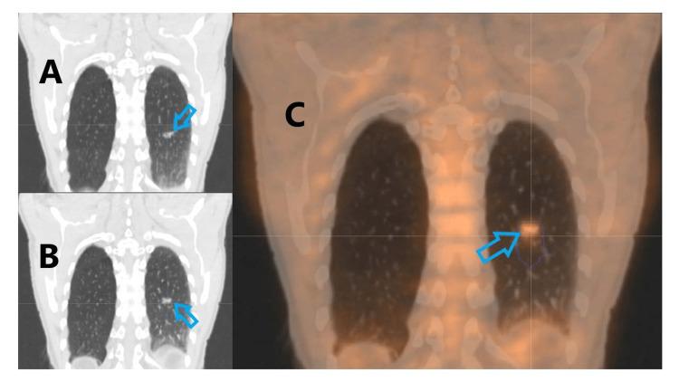 https://cdn.ncbi.nlm.nih.gov/pmc/blobs/ab74/9867792/238e17deb46e/cureus-0014-00000032840-i07.jpg