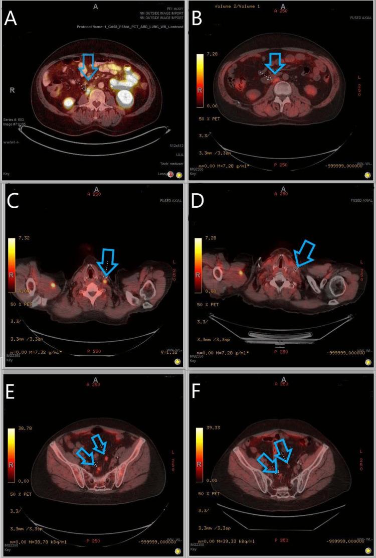 https://cdn.ncbi.nlm.nih.gov/pmc/blobs/ab74/9867792/5e35afbf9c05/cureus-0014-00000032840-i05.jpg