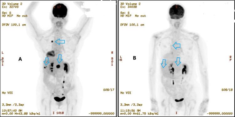 https://cdn.ncbi.nlm.nih.gov/pmc/blobs/ab74/9867792/814c16106310/cureus-0014-00000032840-i06.jpg