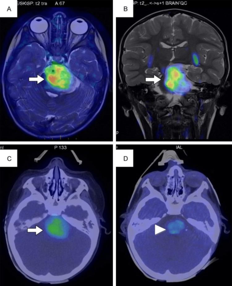 https://cdn.ncbi.nlm.nih.gov/pmc/blobs/ab74/9867792/f08181a9c49d/cureus-0014-00000032840-i03.jpg