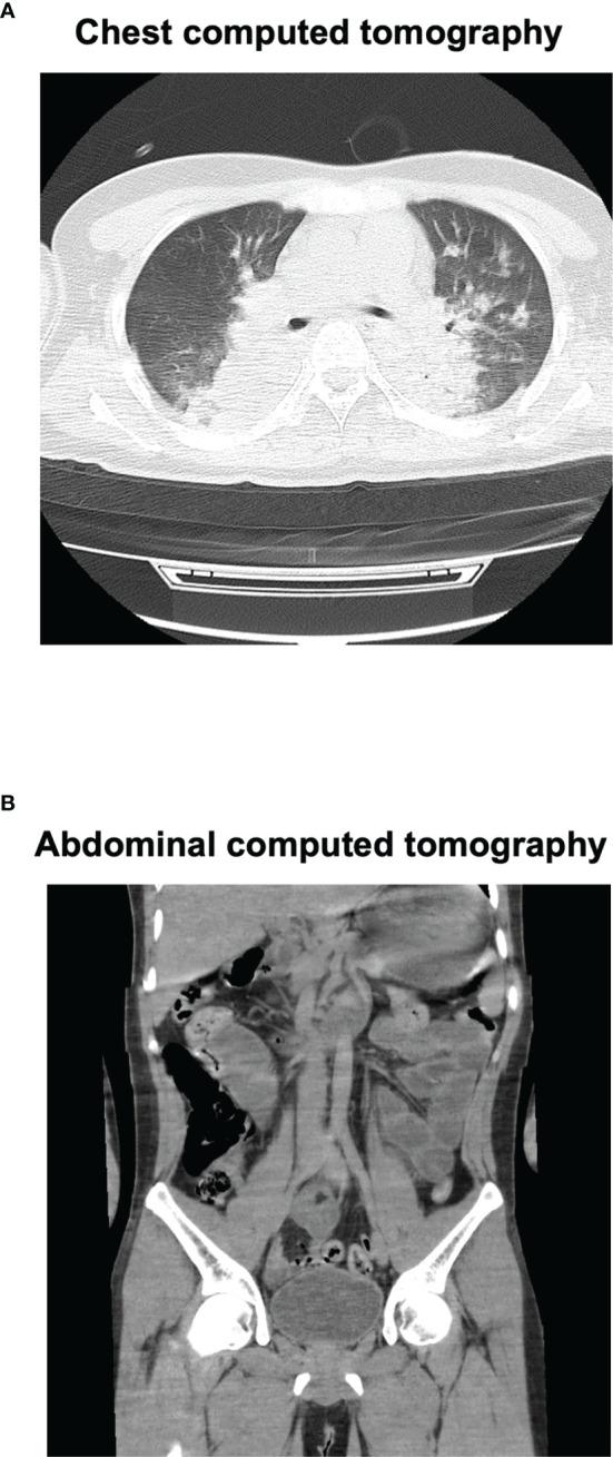 https://cdn.ncbi.nlm.nih.gov/pmc/blobs/abba/8960374/ccda4fc4efd8/fendo-13-822679-g001.jpg