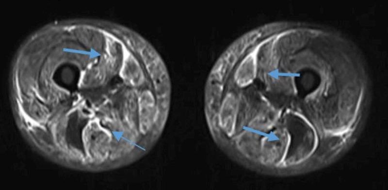 https://cdn.ncbi.nlm.nih.gov/pmc/blobs/abc4/7883527/f402f24c660a/cureus-0013-00000012737-i01.jpg