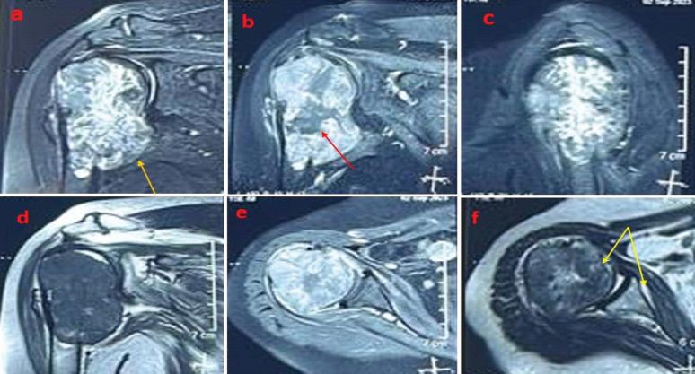 https://cdn.ncbi.nlm.nih.gov/pmc/blobs/abf3/12064254/4ba70467746f/JOCR-15-85-g003.jpg