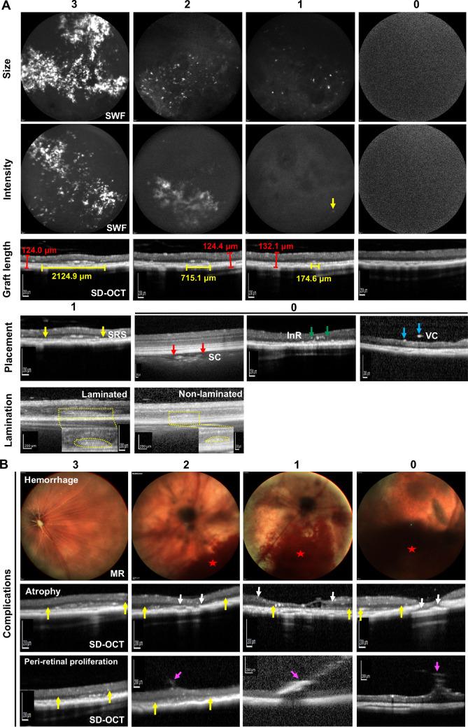 https://cdn.ncbi.nlm.nih.gov/pmc/blobs/ac28/7414711/d3ae81645ce3/tvst-9-7-5-f004.jpg