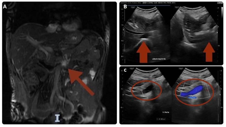https://cdn.ncbi.nlm.nih.gov/pmc/blobs/ac52/12080954/28868525490e/cureus-0017-00000082315-i02.jpg