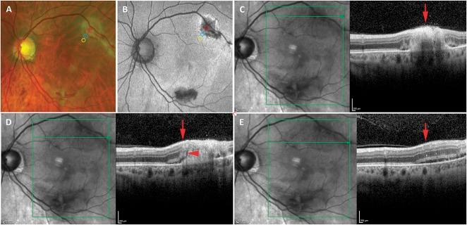 https://cdn.ncbi.nlm.nih.gov/pmc/blobs/ac9b/5943072/27eefd907f5f/retina-38-1000-g004.jpg