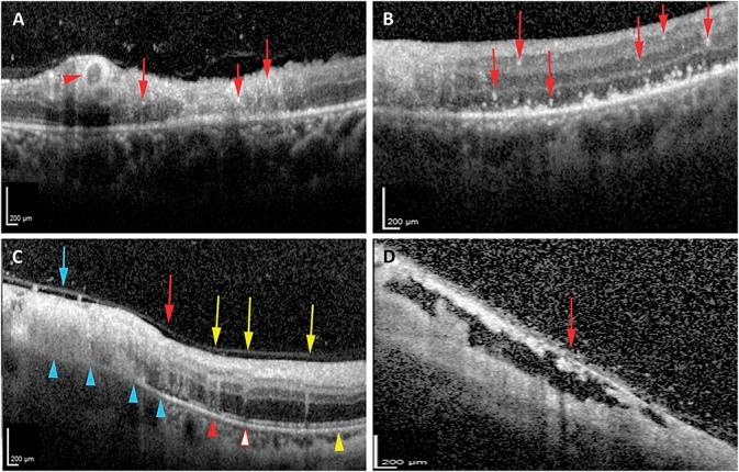 https://cdn.ncbi.nlm.nih.gov/pmc/blobs/ac9b/5943072/d85fcf195d10/retina-38-1000-g003.jpg
