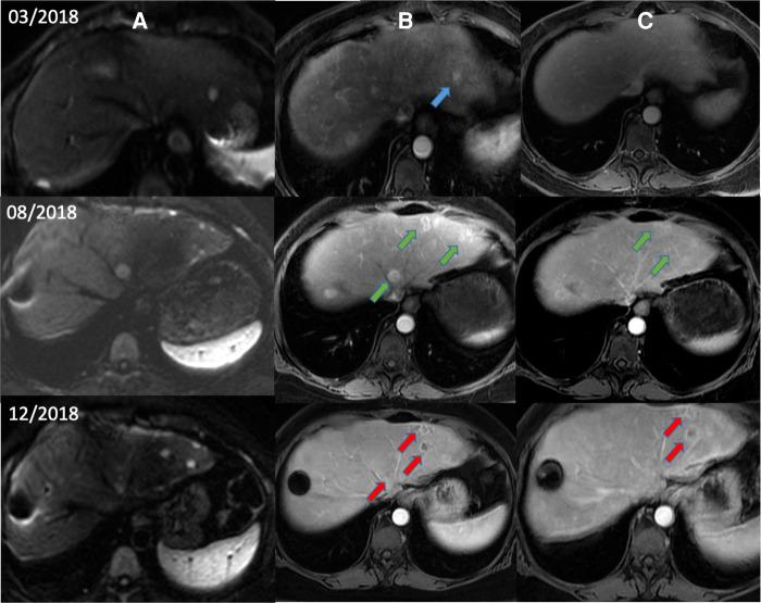https://cdn.ncbi.nlm.nih.gov/pmc/blobs/ad98/9498185/24187f60034a/fmedt-04-869155-g002.jpg
