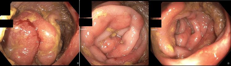 https://cdn.ncbi.nlm.nih.gov/pmc/blobs/ada0/11132664/0d978520fe50/cureus-0016-00000059222-i02.jpg