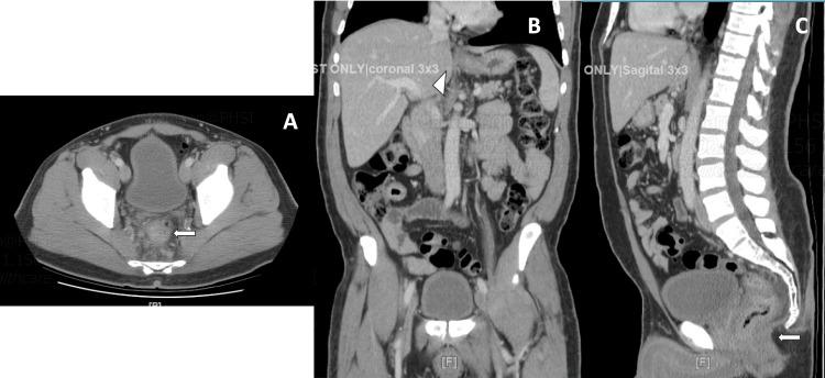 https://cdn.ncbi.nlm.nih.gov/pmc/blobs/ada0/11132664/1a44021bd7c1/cureus-0016-00000059222-i01.jpg