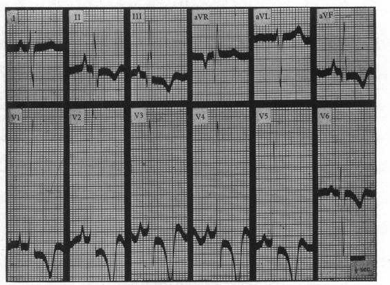 https://cdn.ncbi.nlm.nih.gov/pmc/blobs/adf8/503679/86c617cf14c1/brheartj00403-0094-a.jpg