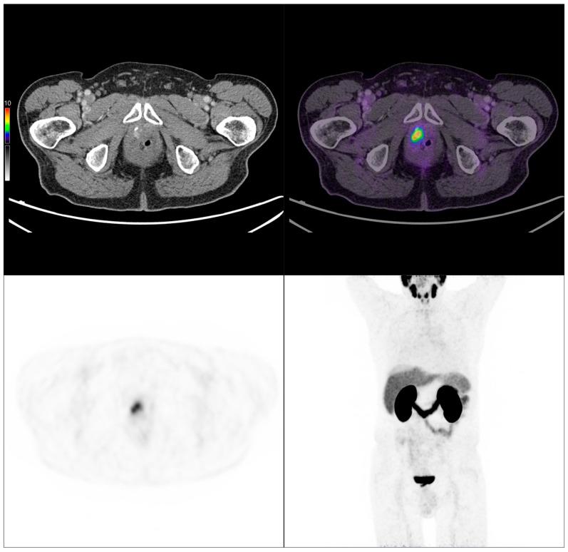 https://cdn.ncbi.nlm.nih.gov/pmc/blobs/aea6/12249072/0ed554295583/cancers-17-02249-g008.jpg