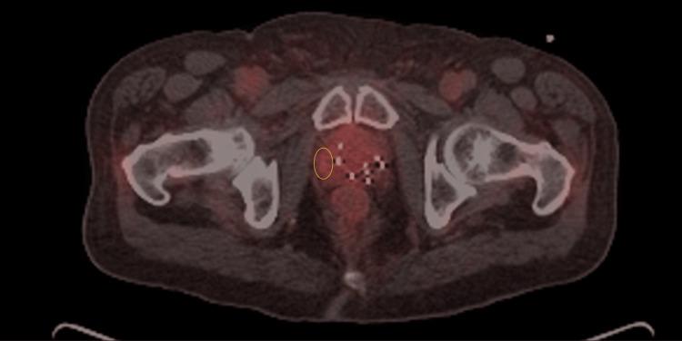 https://cdn.ncbi.nlm.nih.gov/pmc/blobs/aeda/12034341/6988d4574234/cureus-0017-00000081373-i01.jpg
