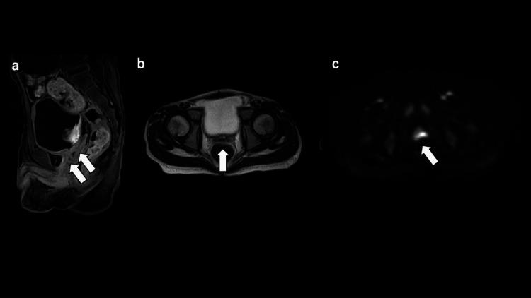https://cdn.ncbi.nlm.nih.gov/pmc/blobs/aee3/9378941/58089494c5b4/cureus-0014-00000026941-i02.jpg